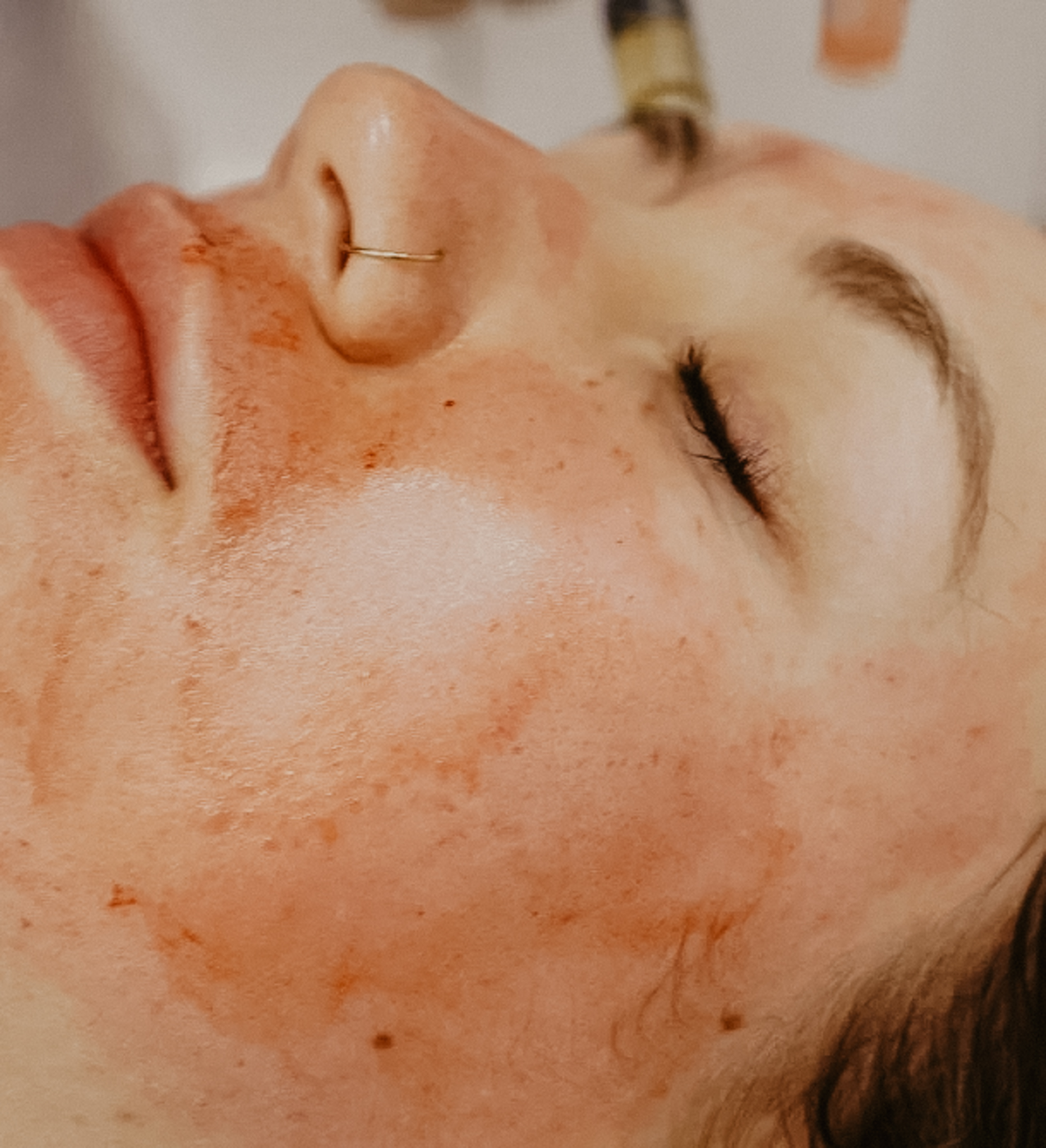 woman laying down receiving a PRP facial 